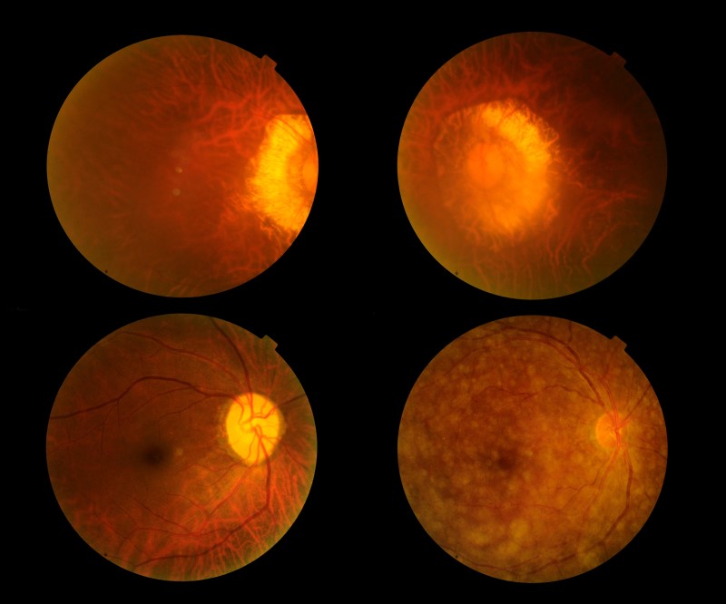 Retina durante el examen del fondo ocular